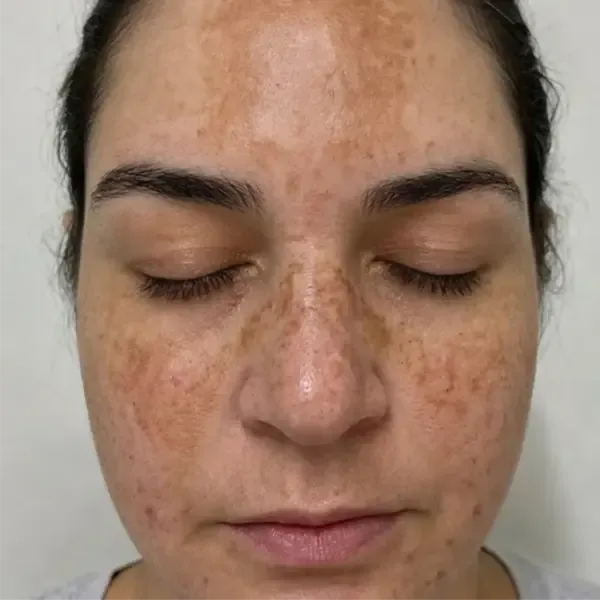Pele antes do Face Clean