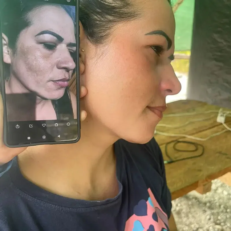 Aplicação na pele