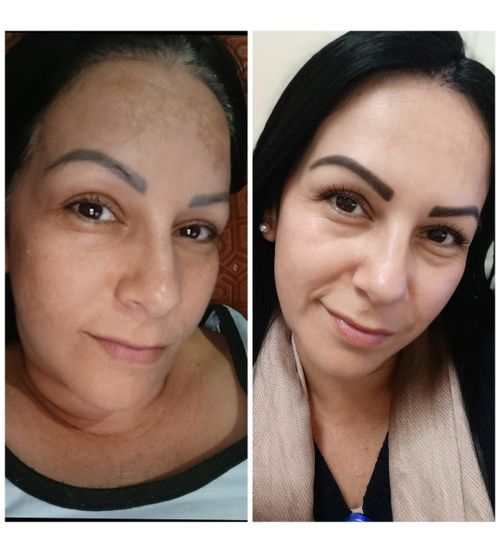 Janayna Rodrigues resultado Face Clean